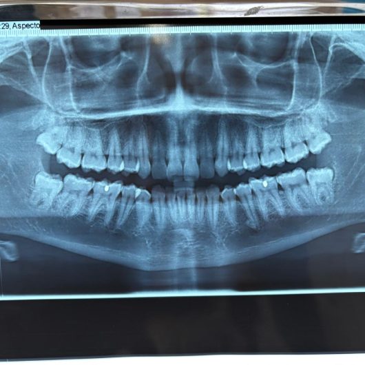 3º Mutirão de Cirurgia Oral agiliza atendimentos para extração de siso no Centro de Especialidades Odontológicas