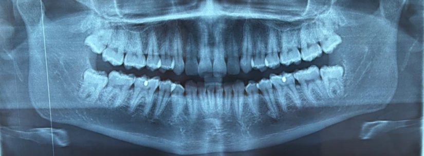 3º Mutirão de Cirurgia Oral agiliza atendimentos para extração de siso no Centro de Especialidades Odontológicas