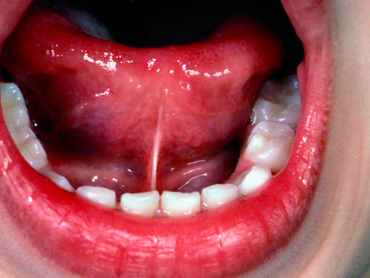 Cirurgia de frenectomia chega à UBS Tinga a partir da próxima semana