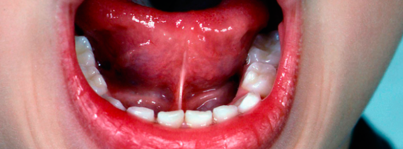 Cirurgia de frenectomia chega à UBS Tinga a partir da próxima semana